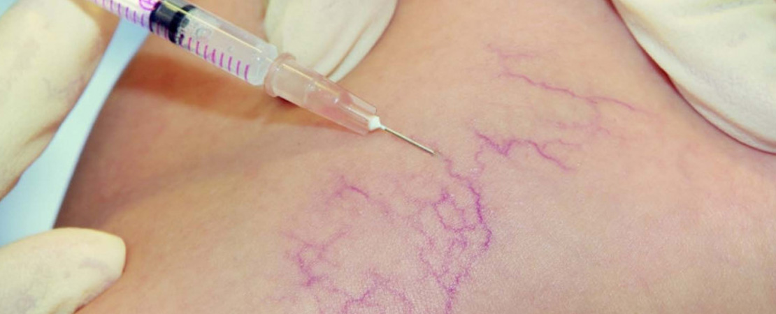 Склеротерапія в Одесі