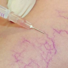 Склеротерапія