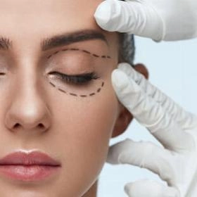 Блефаропластика