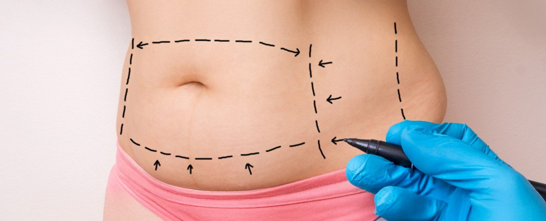 Абдомінопластика в Одесі
