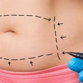 Абдомінопластика