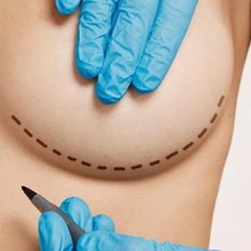 Ліпофілінг грудей