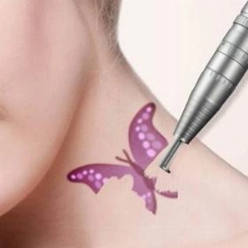 Лазерне видалення татуювання