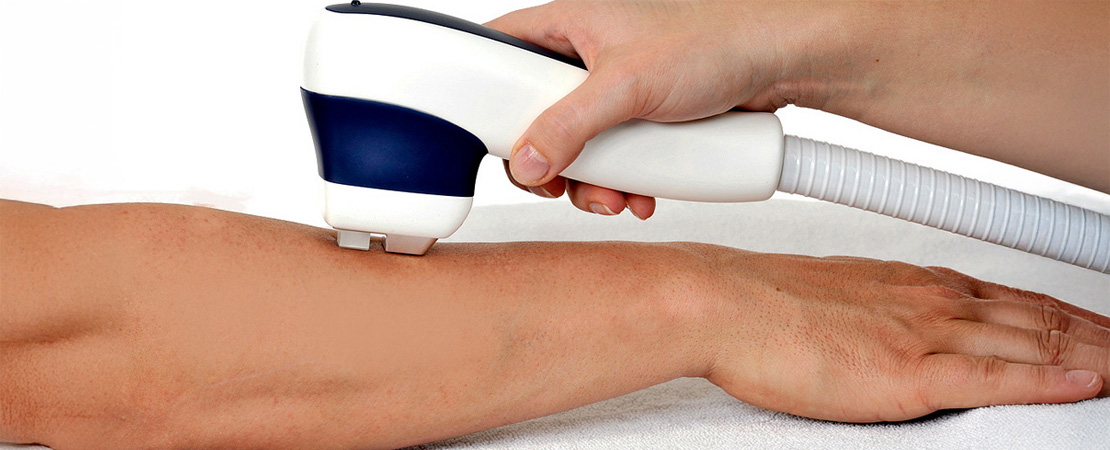 Лазерна епіляція рук в Одесі