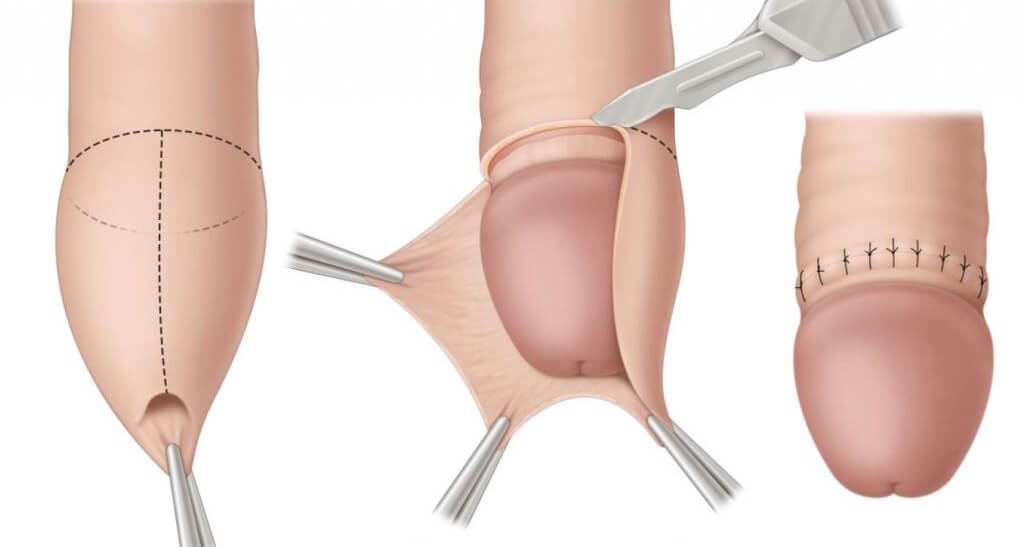 Етапи обрізання