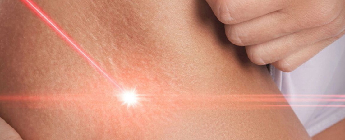 Лазерне шліфування розтяжок в Одесі.