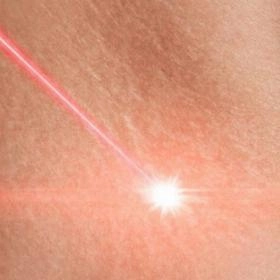 Лазерне шліфування розтяжок