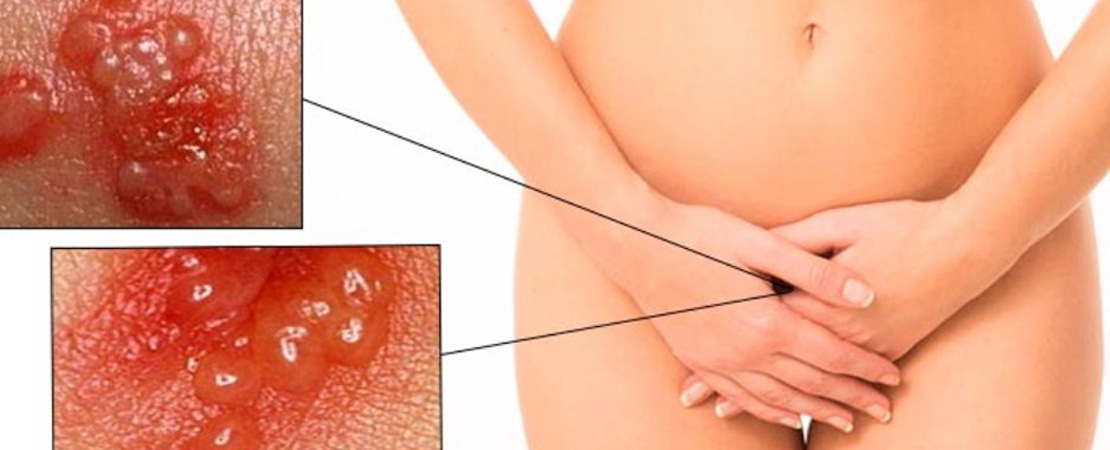 Видалення гострих кондилом в Одесі.