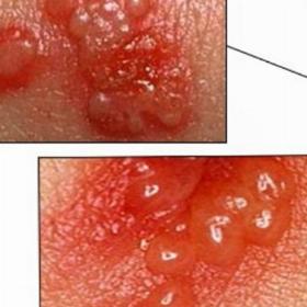 Видалення гострих кондилом 