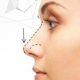 Ринопластика горбинки носа