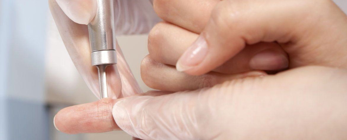 Лазерне видалення бородавок в Одесі