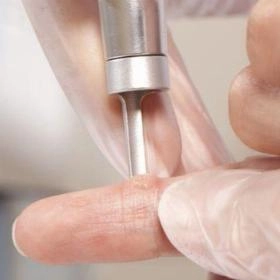 Лазерне видалення бородавок