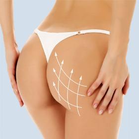 Ліпофілінг сідниць 