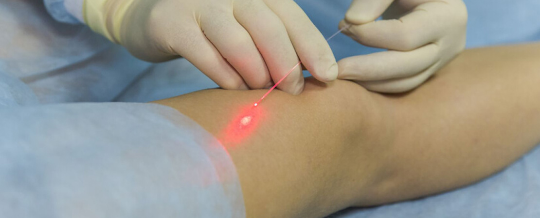 Лазерне лікування варикозу в Одесі.