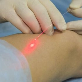 Лазерне лікування варикозу