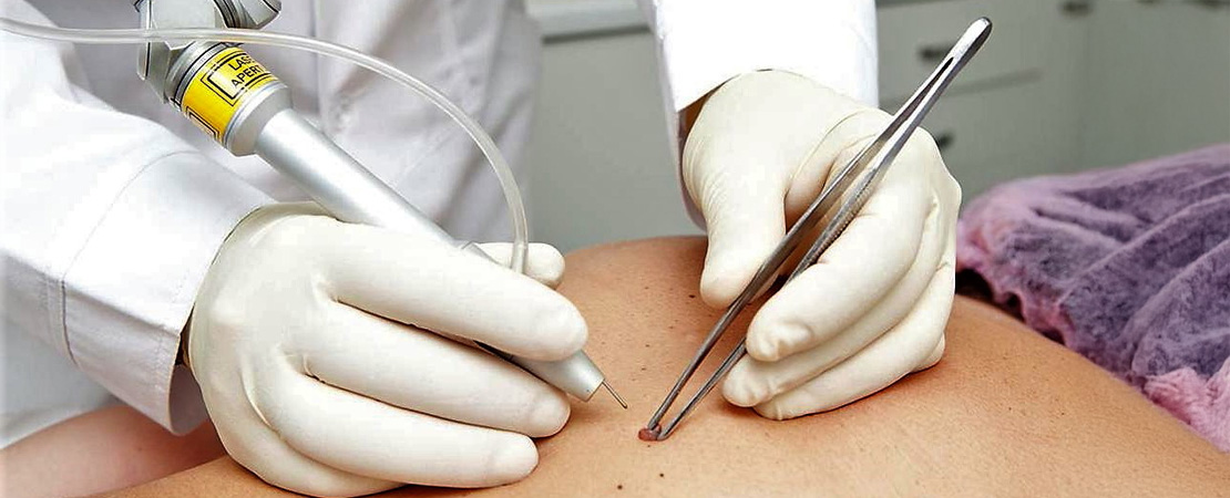 Лазерне видалення родимок в Одесі