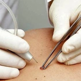 Лазерне видалення родимок