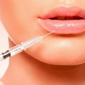 Ліпофілінг губ