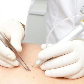 Лазерне видалення новоутворень