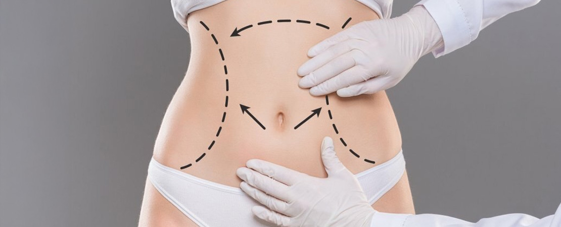 Ультразвукова Vaser ліпосакція живота в Одесі.