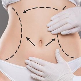 Ліпосакція живота 