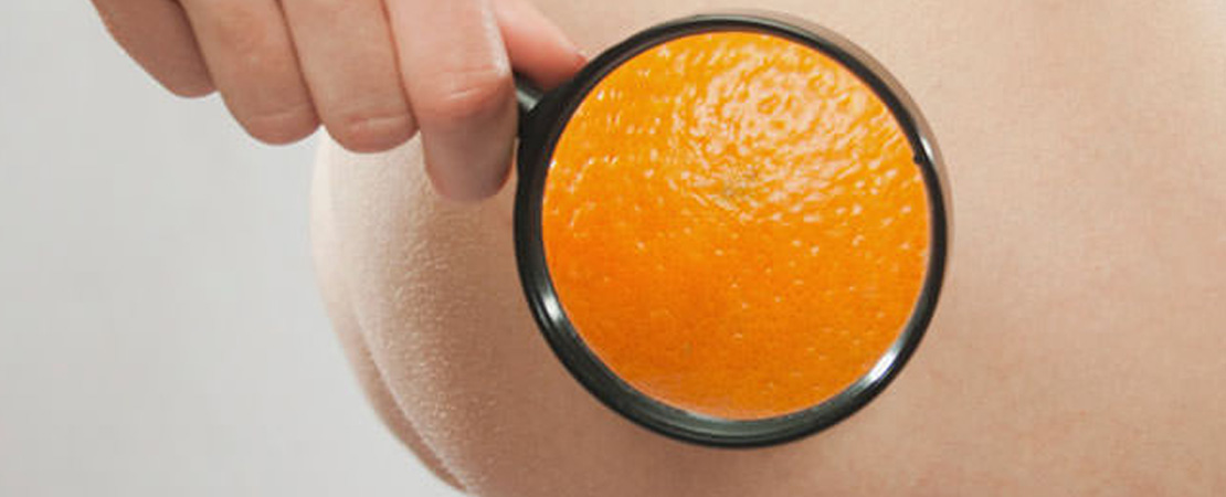 Лікування целюліту в Одесі.