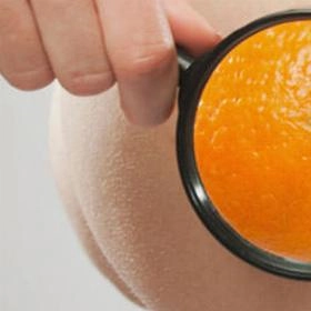 Лікування целюліту