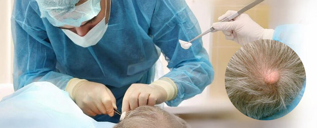 Видалення атероми в Одесі