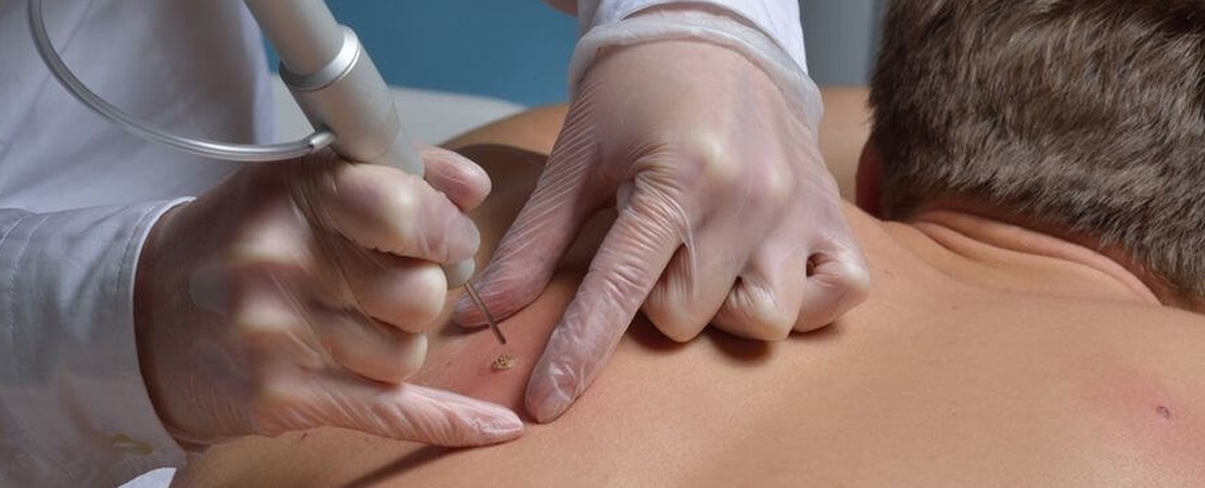 Видалення ліпоми (жировика) в Одесі