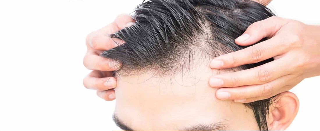 Міфи і правда про пересадку волосся