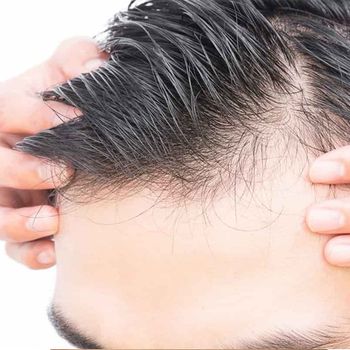 Міфи і правда про пересадку волосся