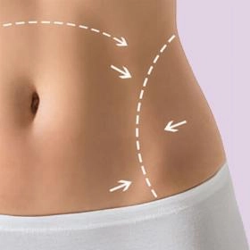 Мініабдомінопластика