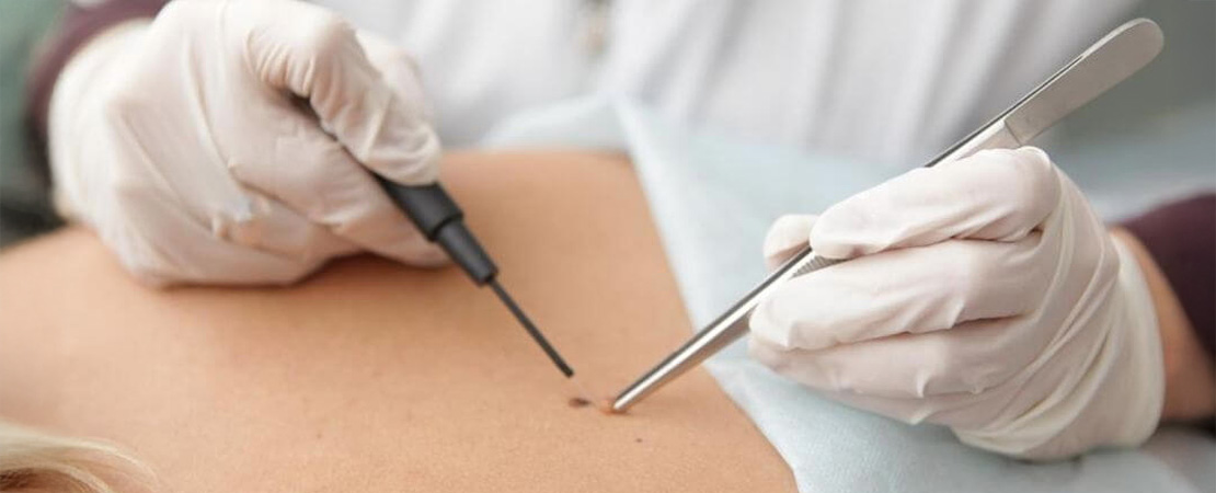 Видалення новоутворень в Одесі