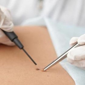 Видалення новоутворень Surgitron от 60 грн