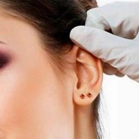 Отопластика