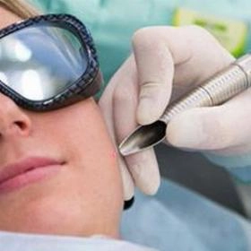 Лазерне видалення папілом