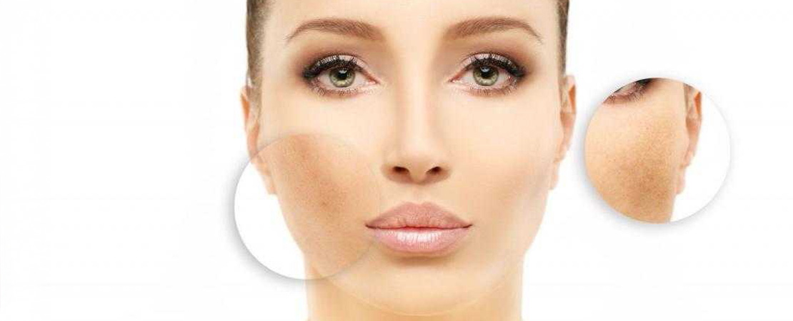 Лазерне видалення пігментних плям в Одесі