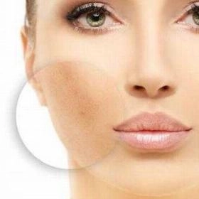 Лазерне видалення пігментації