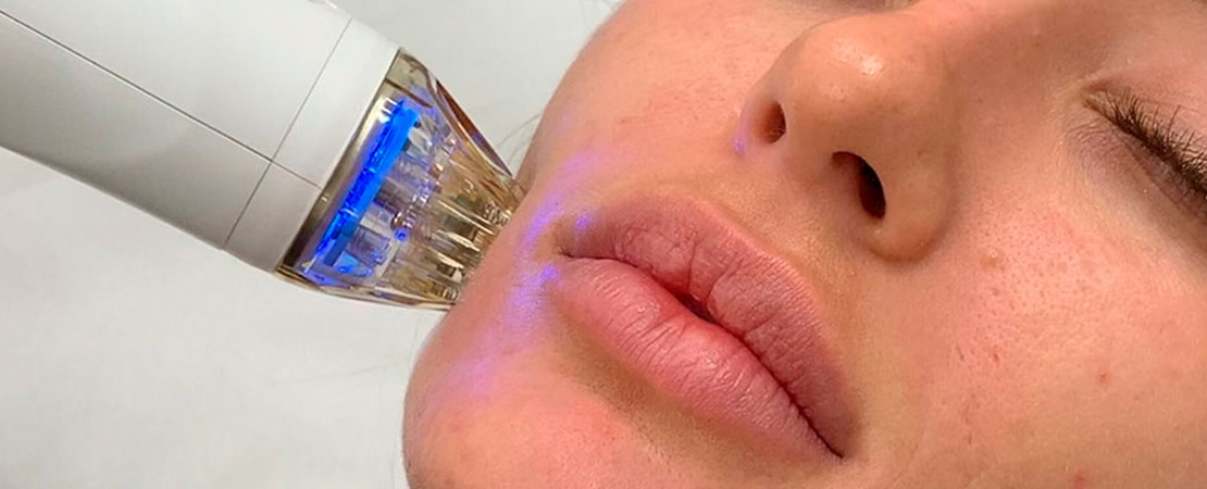 Мікроігольчастий RF/РФ ліфтинг в Одесі