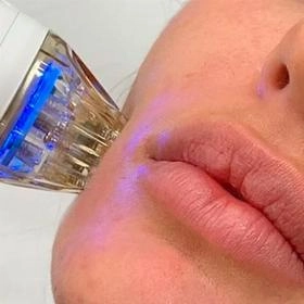 Мікроголчастий RF ліфтинг