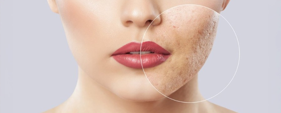 Лазерная шлифовка  кожи лица в Одессе