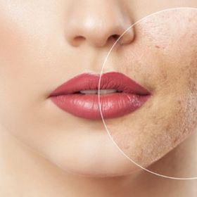 Лазерне шліфування обличчя до -50%