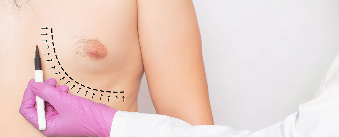 Лікування гінекомастії в Одесі