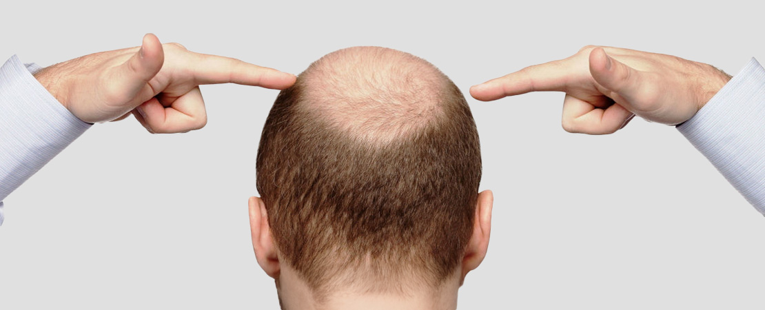 Пересадка волосся на голові методом FUE та HFE в Одесі