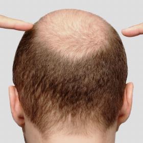 Пересадка волосся на голові до -20%