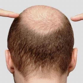 Пересадка волосся на голові