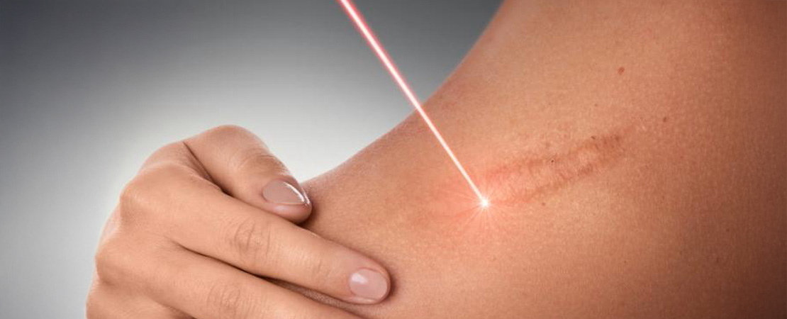 Лазерне шліфування рубця (шраму) в Одесі.