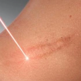 Лазерне шліфування рубця