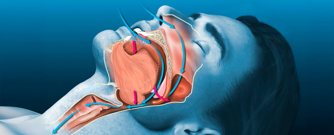 Лікування хропіння (апное) в Одесі.