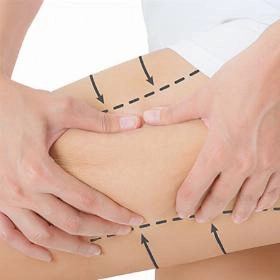 Ліпосакція ніг